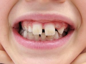 Junge Zähne: Karies bleibt weit verbreitet (Foto: pixelio.de, Thommy Weiss)