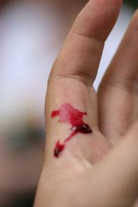 Fingerwunde: Klebstoff stoppt Blutung schnell (Foto: pixelio.de, Maren Beßler) Fingerwunde: Klebstoff stoppt Blutung schnell (Foto: pixelio.de, Maren Beßler)