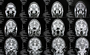 Gehirn-Scans: Viele Funktionen sind noch ungeklärt (Foto: Rike/pixelio.de)
