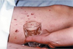 Glas-Test: Das ist für Facebook offenbar anstößig (Foto: meningitisnow.org)