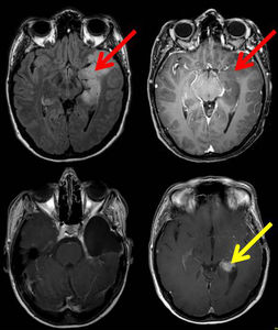 Gliom (rot), das entartet ist. Bösartiger Tumor (gelb) (Foto: Matthias Simon)