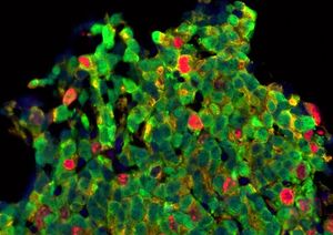 Speziell behandelte Zellen bei Prostatakrebs (Foto: icr.ac.uk, Johann de Bono)