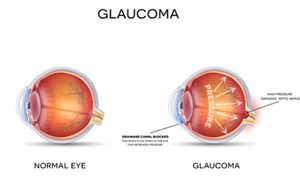 Kontrolle bei Verdacht auf Glaukom wichtig (© reineg - Fotolia)