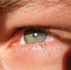 Auge: Glaukom-Patienten wird geholfen (Foto: pixelio.de, Jessica Roitzheim)