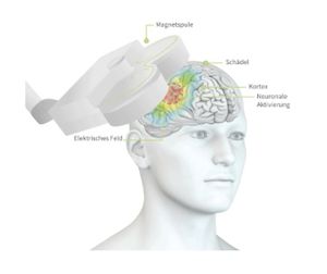 rTMS-Behandlung bei Depressionen in München (Foto: neuroCare Group München)