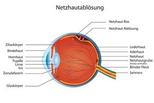 Netzhautablösung: Dringend einen Augenarzt aufsuchen (© bilderzwerg - Fotolia)