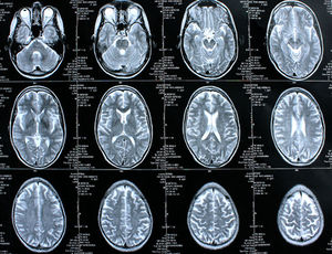 Gehirn im Scan: Dopamin relevant für gute Funktion (Foto: pixelio.de, Rike)