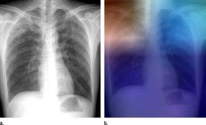 Röntgen (links) und Analyse über Künstliche Intelligenz (Foto: rsna.org) Röntgen (links) und Analyse über Künstliche Intelligenz (Foto: rsna.org)