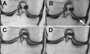 Knieglenke: Gewicht belastet die Knorpel entscheidend (Foto: RSNA)