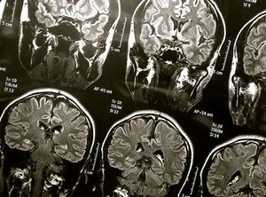 Gehirn-Scans: Chip steckt bald direkt im Gehirn (Foto: flickr.com/wyinoue)