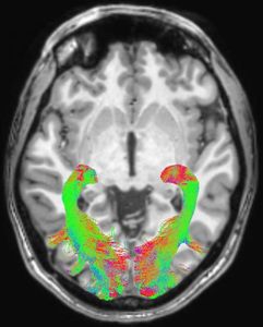 Gehirn-Scan: Strukturen verändern sich frühzeitig (Foto: rsna.org)