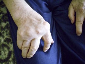 Rheumatoide Arthritis: Beruf als Risikofaktor (Foto: pixelio.de, Uta Herbert)