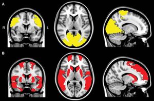 Gehirn-Scans: Parkinson verändert die Kommunikation im Kopf (Foto: rsna.org)