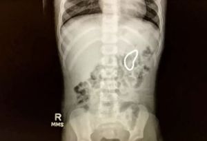 Röntgenbild der kleinen Patientin: Magen mit 28 Magnetkugeln (Foto: kdvr.com)