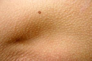 Haut: gesund durch Listeria-Bakterien (Foto: Alexandra Bucurescu, pixelio.de)