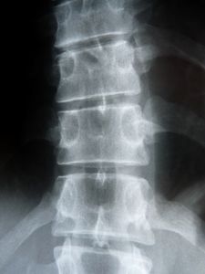 Röntgenbild der Wirbelsäule: Graphen hilft (Foto: pixelio.de/Dieter Schütz)