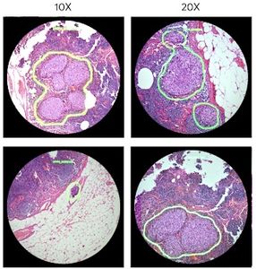 Verdächtig: KI markiert potenzielle Tumore (Foto: research.googleblog.com)