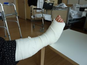 Gipsbein: Osteoporose kann vorgebeugt werden (Foto: pixelio.de/sparkie)