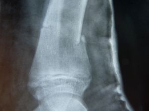 Knochenbruch: Gicht erhöht Risiko nicht (Foto: pixelio.de, Dieter Schütz) Knochenbruch: Gicht erhöht Risiko nicht (Foto: pixelio.de, Dieter Schütz)