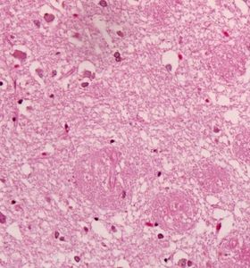 Gewebeprobe: Biomarker verraten Alzheimer-Lebensrisiko (Foto: ph.ucla.edu)