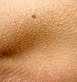 Muttermal: Apps ersetzen Mediziner nicht (Foto: pixelio.de, Alexandra Bucurescu)