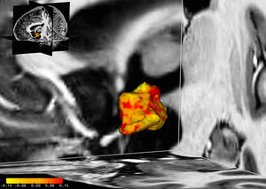 Linker Hypothalamus im Detail (Bild: cbs.mpg.de, Acta Psychiatrica Scandinavica)