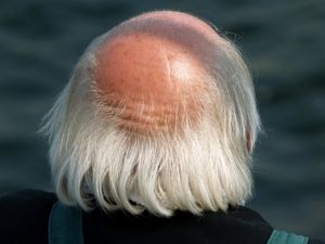 Glatze im Alter: Neuer Ansatz verspricht Abhilfe (Foto: pixelio.de, Sokaeiko)