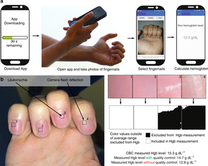 Für die Anämie-Diagnose reicht ein Fingernagel-Foto (Bild: emory.edu, nature)