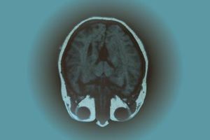 Gehirn: Schizophrenie-Symptome gelindert (Foto: pixelio.de, Monika Torloxten)