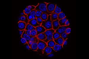Krebs: Kranke Zellen (blau) in der Bauchspeicheldrüse (Foto: Min Yu/USC)