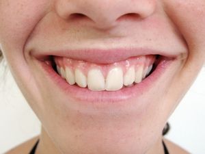 Gesunder Mundraum senkt Risiko für Leberkrebs (Foto: Thommy Weiss, pixelio.de) Gesunder Mundraum senkt Risiko für Leberkrebs (Foto: Thommy Weiss, pixelio.de)