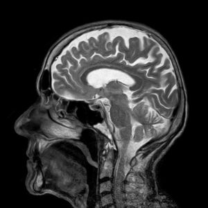 Gehirn-Röntgen: Blutversorgung verschlechtert sich (Foto: Pixabay, toubibe)