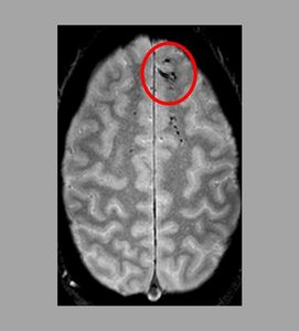 Läsionen: Mikroblutungen nun sichtbar gemacht (Foto: Latour Lab/ninds.nih.gov)