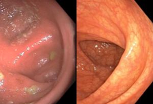 Entzündeter und nach Phototherapie regenerierter Darm (rechts) (Foto: nejm.org)