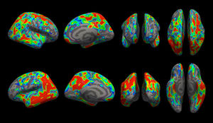 Gehirn im Scan: Farbe zeigt den Verlust von Synapsen (Foto: yale.edu)