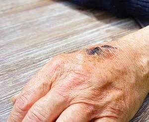 Hautverletzung: Bakterien begünstigen Heilung (Foto: pixabay.com, Hans)
