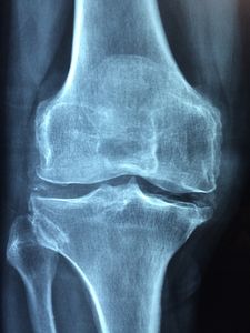 Knie: Chronische Schmerzen belasten (Foto: pixabay.de/Dr. Manuel González Reyes)
