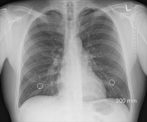 Lungenröntgen: Fibrose verhärtet das Gewebe (Foto: pixabay.com, oracast)
