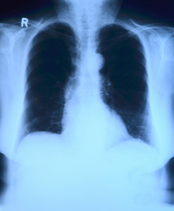 Röntgenbild der Lunge: KI erkennt COVID-19 (Foto: pixabay.com, toubibe)