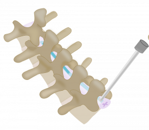 So wird das schmerzstillende Gerät platziert (Grafik: University of Cambridge)