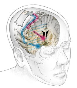 Gehirnimplantat: Depressionen erfolgreich therapiert (Ken Probst, ucsf.edu)