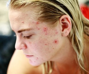 Akne: Vor allem Teens werden befallen (Foto: Sharon McCutcheon, pixabay.com)