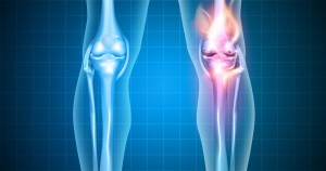 Osteoarthritis: US-Forscher entwickeln spezielles Gel zur Schmerzlinderung (Bild: nyu.edu)