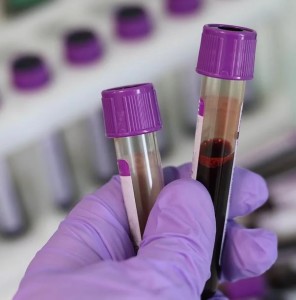 Ampullen mit Blut: Protein als Nachweis für eine Demenz (Foto: pixabay.com, Belova59)