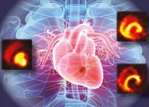 Veränderungen im Zuckerstoffwechsel des Herzmuskels nach einem Herzinfarkt (Bild: ethz.ch, uzh.ch)