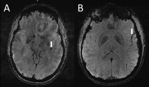 Gehirne im Vergleich: hochauflösende MRT-Bilder zeigen Migräne-Ursachen (Foto: rsna.org, Wilson Xu)