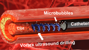 So wirkt der wirbelnde Ultraschall auf Blutgerinnsel (Illustration: Xiaoning Jiang, ncsu.edu)