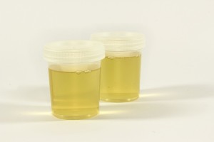 Urinproben im Testbecher: erstaunliche Diagnose von Blasenkrebs (Foto: Ewa Urban, pixabay.com)