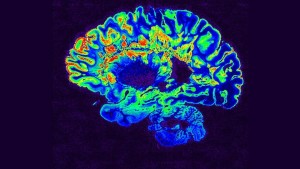 Mózg pacjenta ze stwardnieniem rozsianym: zaatakowane komórki wydają się czerwone (Zdjęcie: hopkinsmedicine.org)