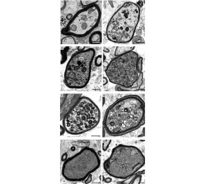 Aufnahmen einzelner Nervenfasern in MS-Hirnbiopsien im Querschnitt (Fotos: uni-leipzig.de) Aufnahmen einzelner Nervenfasern in MS-Hirnbiopsien im Querschnitt (Fotos: uni-leipzig.de)